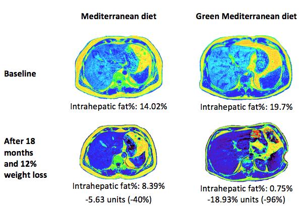 Ben-Gurion U. Study Green Med vs. Med Diet Intrahepatic Fat Loss