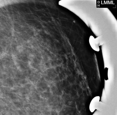 Stereotactic Biopsy Revealed DCIS