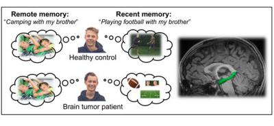 Brain tumors in Children, Radiation Therapy and Memory
