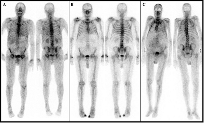 Images of patient examples considered as low-grade uptake.