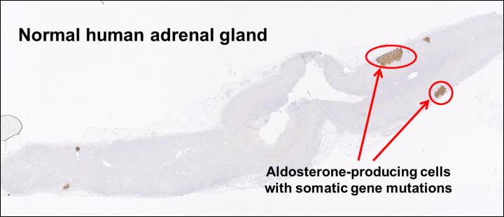 Adrenal Gland with Abnormal Cell Clusters