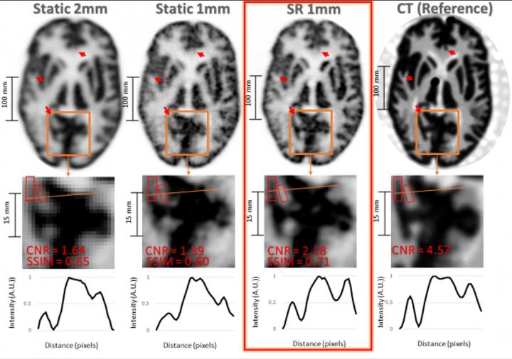 Result of the Hoffman brain phantom study.