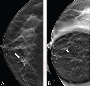 Digital breast tomosynthesis spot compression | EurekAlert!