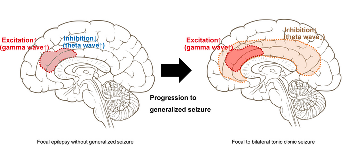 Study shows that Hebbian and homeostatic plasticity differentially regulate brain function in epilepsy