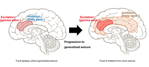 Study shows that Hebbian and homeostatic plasticity differentially regulate brain function in epilepsy