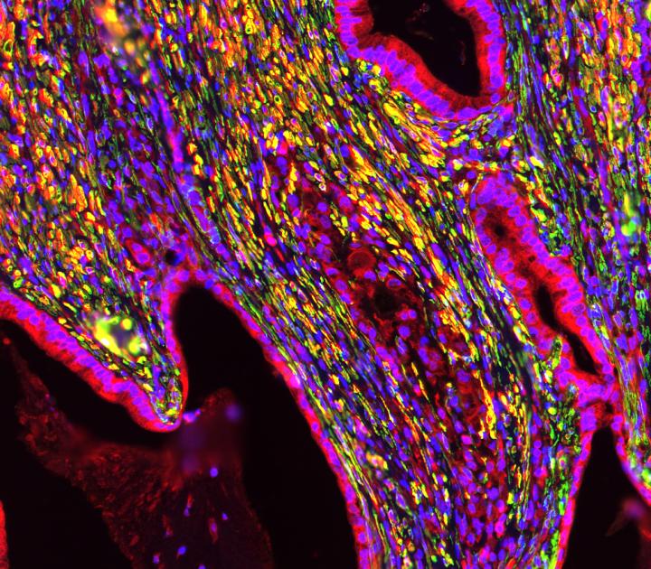 Human pancreatic tumor section