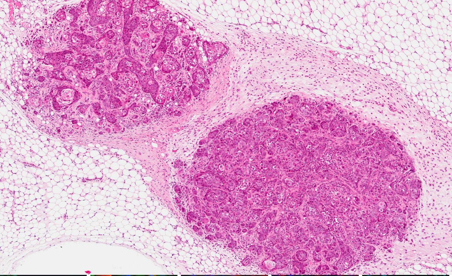 Breast Cancer Model 184AA3