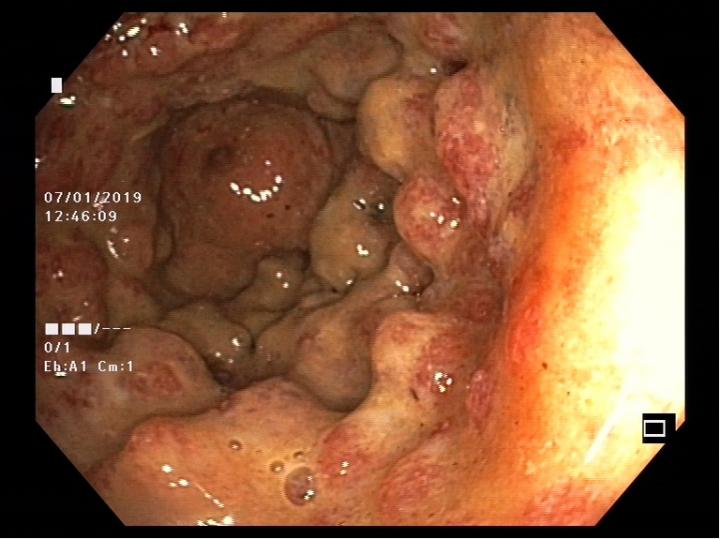 Colon with Ulcerative Colitis
