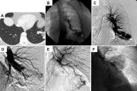 Smoking Impedes Embolization Treatment in Lungs - Image 2