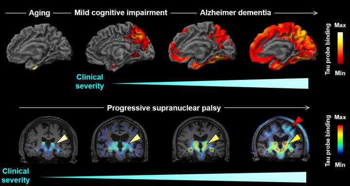 Tau and Aβ imaging, CSF measures, and cognition in Alzheimer's disease