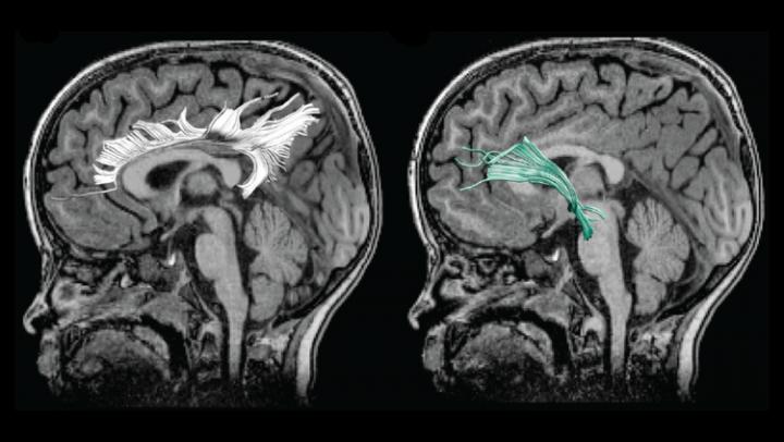 Prenatal Depression Alters Child's Brain Connectivity, Affects Behavior