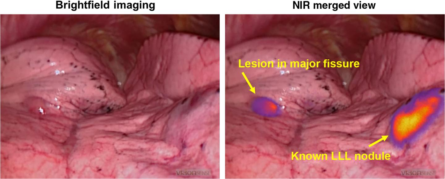 NIR Merged View of Osteosarcoma Metastases