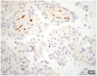BAP1 Immunohistochemistry of a Rhabdoid Meningioma Sample