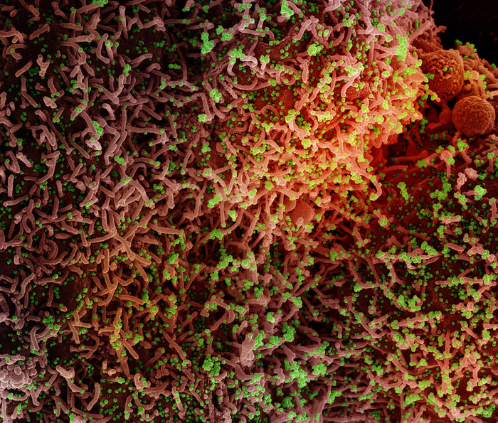 Colorized scanning electron micrograph of a cell infected with SARS-CoV-2 virus