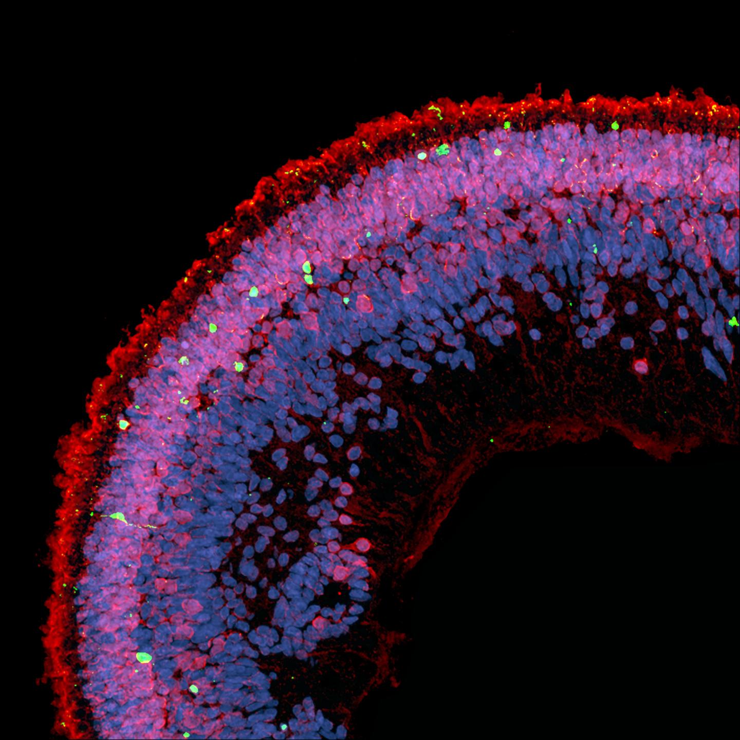 Ddeoxysphingolipids Damage the Retina in Patients with MacTel