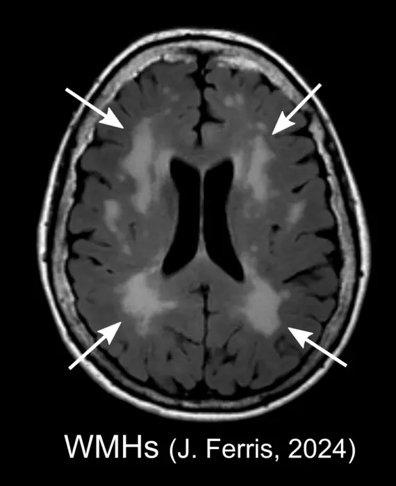 white matter hyperintensities