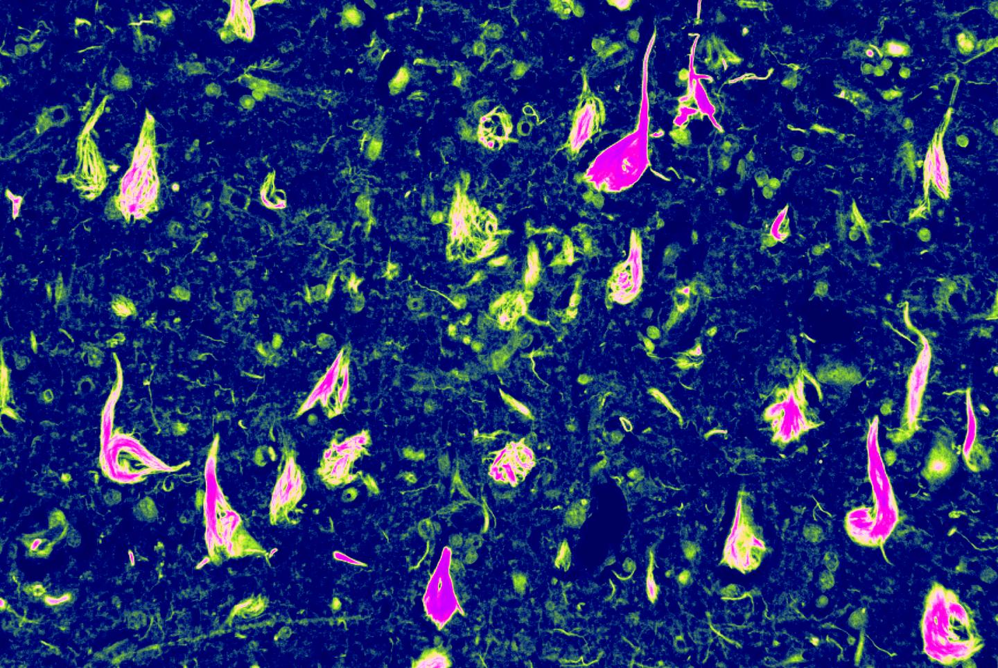 Neurofibrillary Tangles image 1