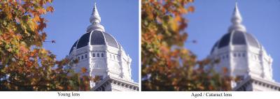 Normal and Cataract Vision