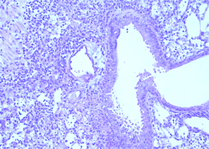 Monocyte deficiency leads to a severe gammaherpesvirus–associated disease