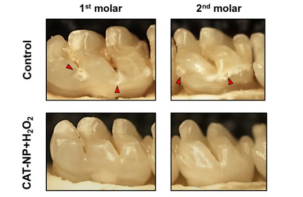 Nanoparticle-Hydrogen Peroxide Treatment Prevents Tooth Decay