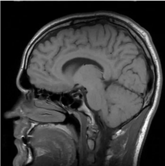 Researchers explore the cerebellar manifestations that set apart Parkinson’s disease brains from healthy brains