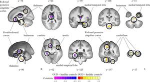 Tensor-based morphometry (TBM) analysis of T1-weighted MRI scans shows a comparison of brain volumes in participants with opioid use disorder (OUD) and healthy control participants.