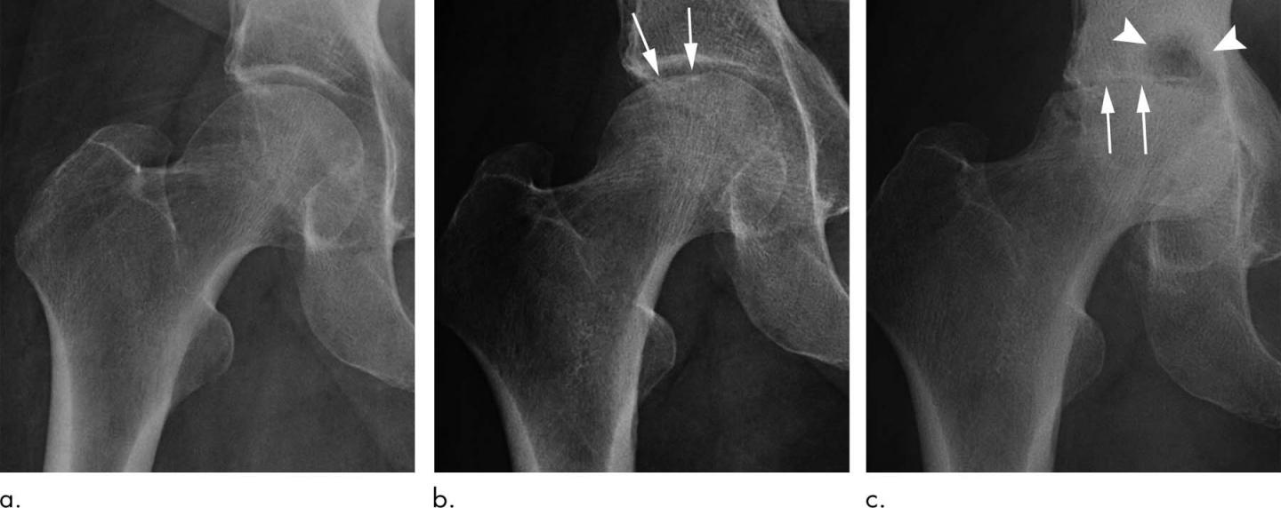 Steroid injections of hip and image eurekalert science news releases