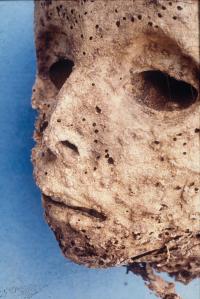 DNA analysis of ancient mummy, thought to have smallpox, points to hepatitis B instead