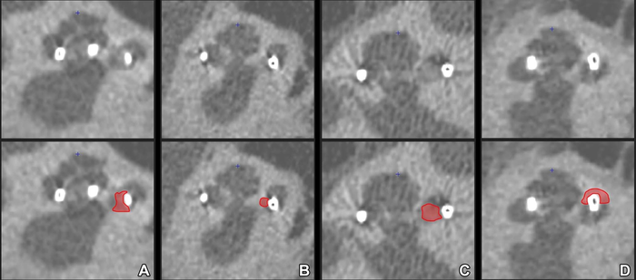 Cochlear Implants Linked to New Bone Formation, Increased Hearing Loss