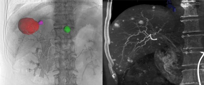 Application of Cone-beam Computed Tomography in Interventional Therapies for Liver Malignancy: A Consensus Statement by the Chinese College of Interventionalists