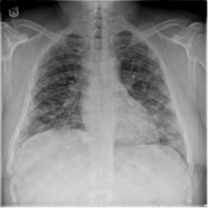 Lung Image