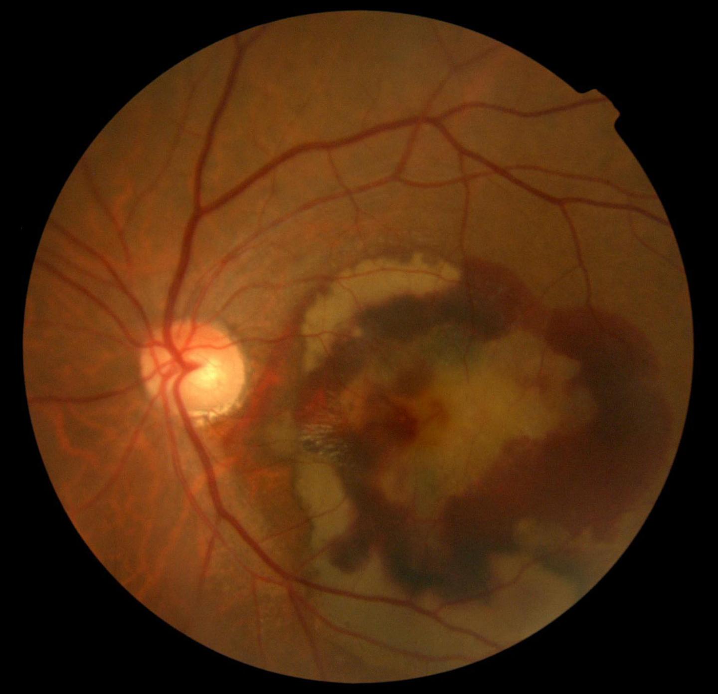 Reproducing a Retinal Disease on a Chip