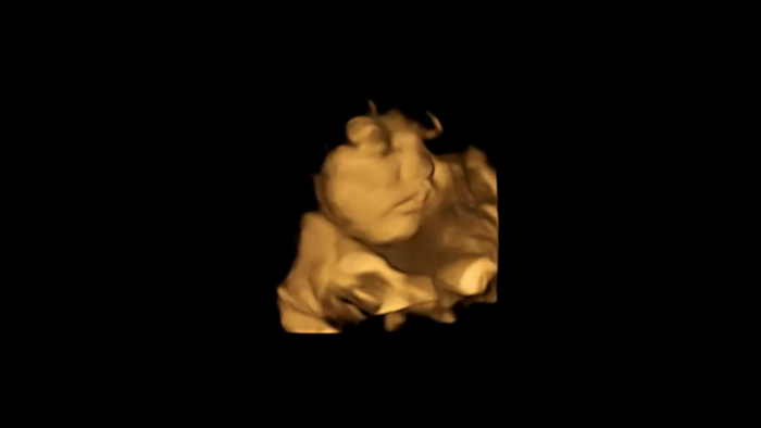 Cry-face baseline scan image.jpg