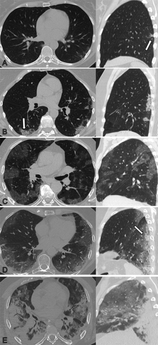 Lung Damage May Persist Long After COVID-19 Pneumonia