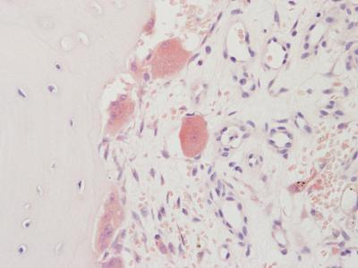 Osteolysis no treatment