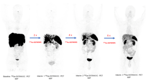 Excellent sustained response in a 34-year-old male with pancreatic NET.