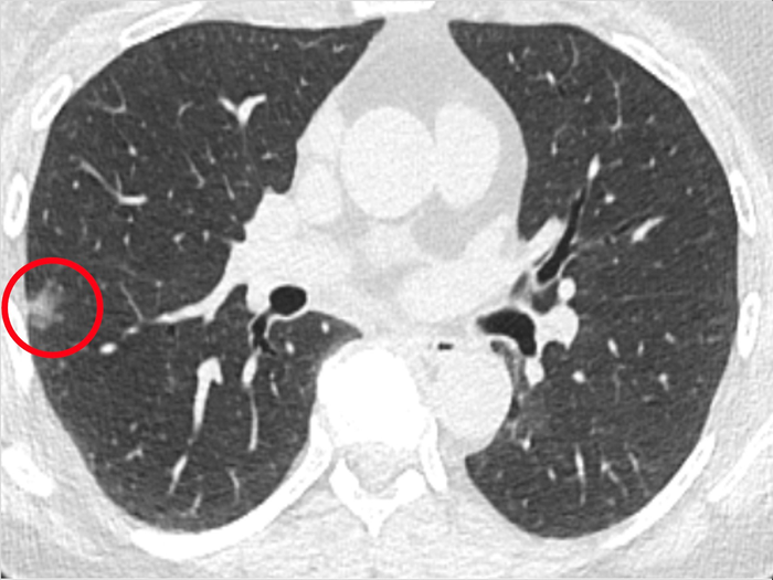 Patient Scan with Lung Nodule Circled