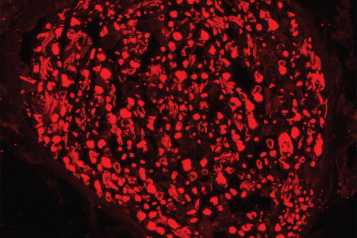 Gene therapy Blocks Peripheral Nerve Damage in Mice