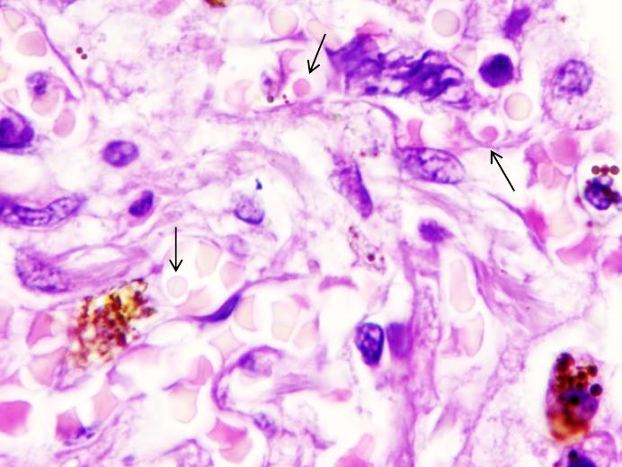 Lung Parenchyma Of Patient, B