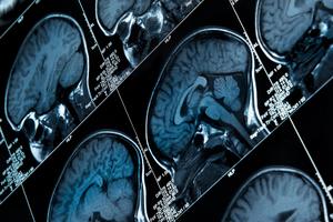 Brain images - new research shows impact of COVID on people with epilepsy