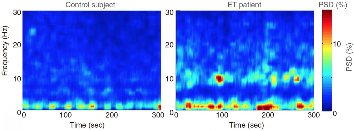 EEG Reveals Abnormal Brain Waves in Essential Tremor Patients