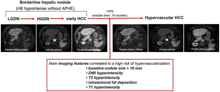 Hepatobiliary Phase Hypointense Nodules without Arterial Phase Hyperenhancement