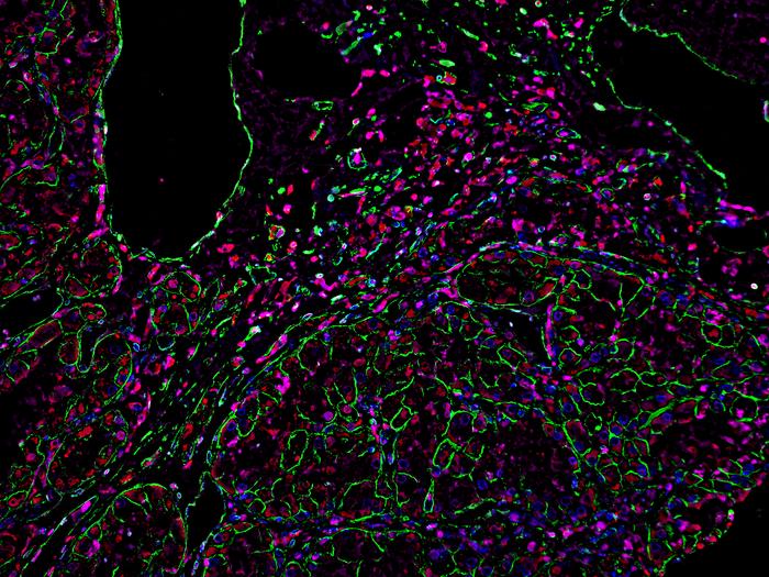 Macrophages in kidney cancer [IMAGE] | EurekAlert! Science News Releases