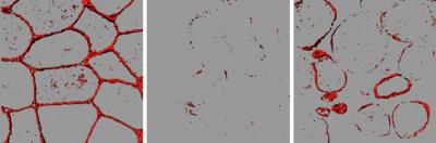 3-D Reconstructions of Dysferlin Localization in Muscle Biopsies