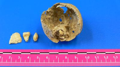 Ovarian Tumor, with Teeth and a Bone Fragment Inside, Found in a Roman-age Skeleton