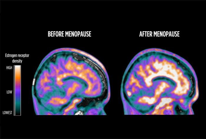 PET scans showing brain estrogen receptor (ER) density in a premenopausal (left) and a postmenopausal (right) woman.
