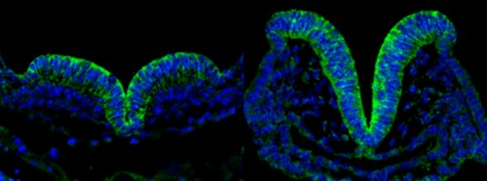 Premature aging in neural tissue from fetuses with diabetic mothers