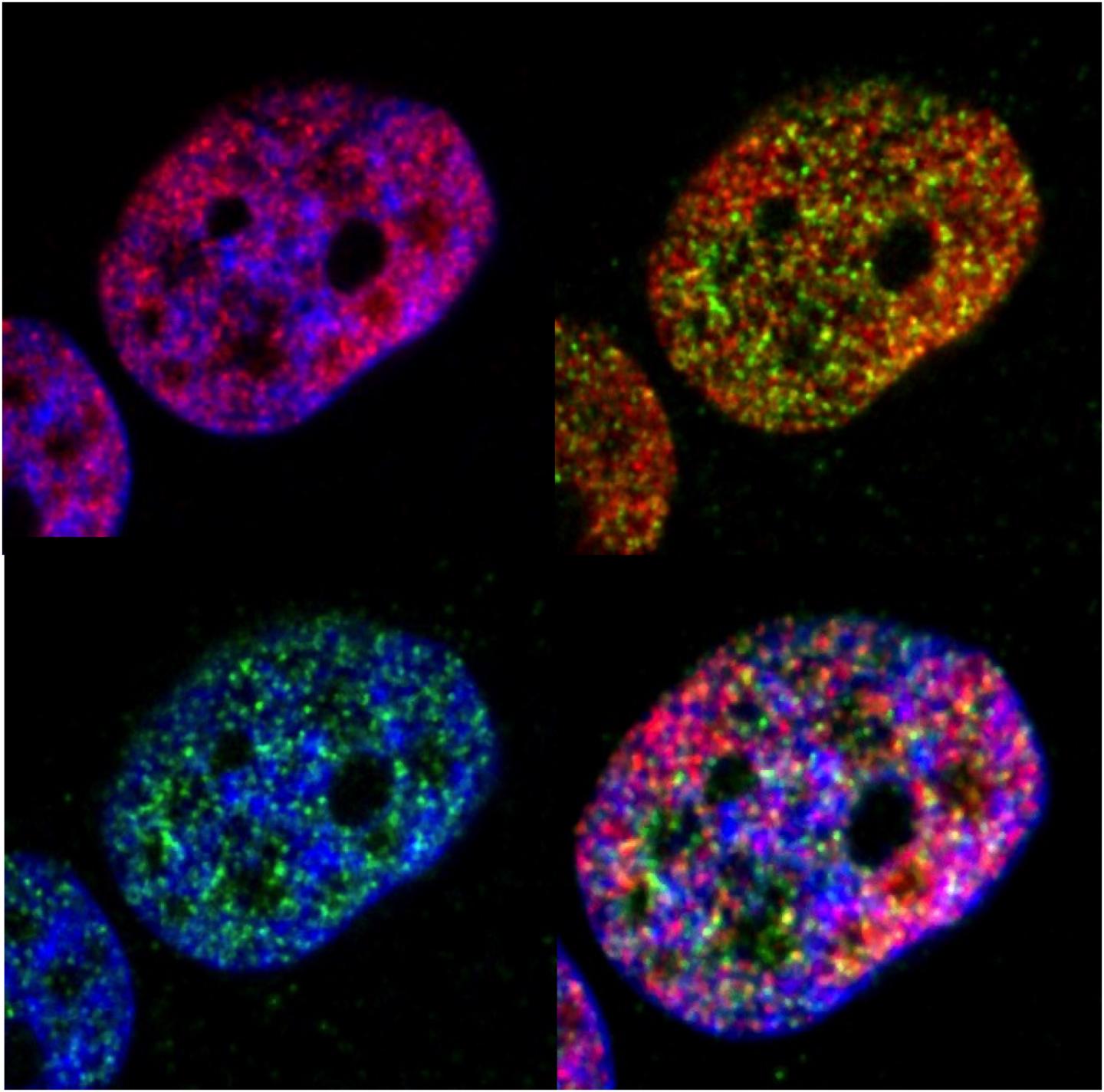 Gene Silencing at Breast Cancer Cells