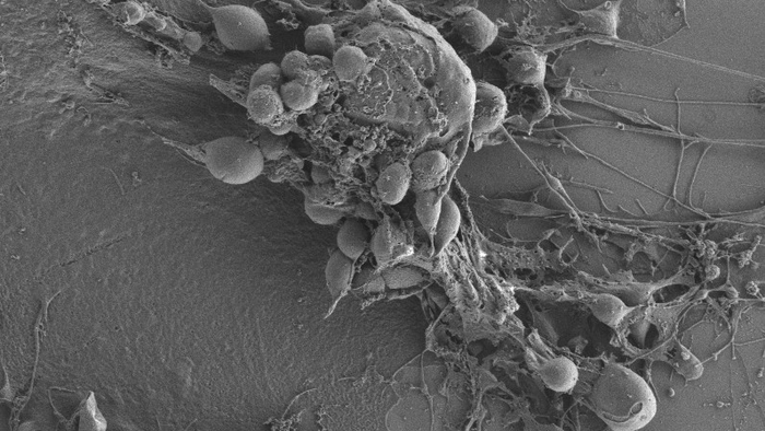 Human glioblastoma cell treated with gossypol, observed through the freeze-fracture field emission-scanning electron microscopyv