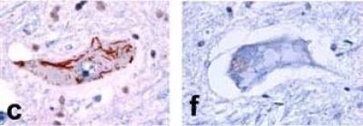 Finding Suggests Drug Discovery for Lou Gehrig's Disease Be Re-examined